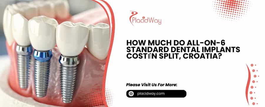 All-on-6 Standard Dental Implants Cost in Split, Croatia