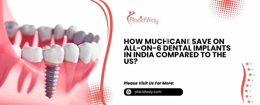 All-on-6 dENTAL IMPLANTS in India 