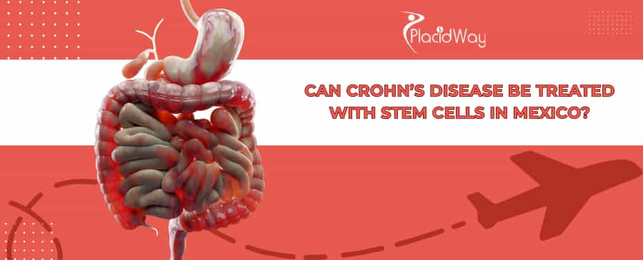 Crohn’s Disease Stem Cell Therapy in Mexico