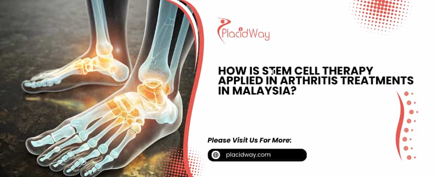Stem Cell Therapy Applied in Arthritis Treatments in Malaysia