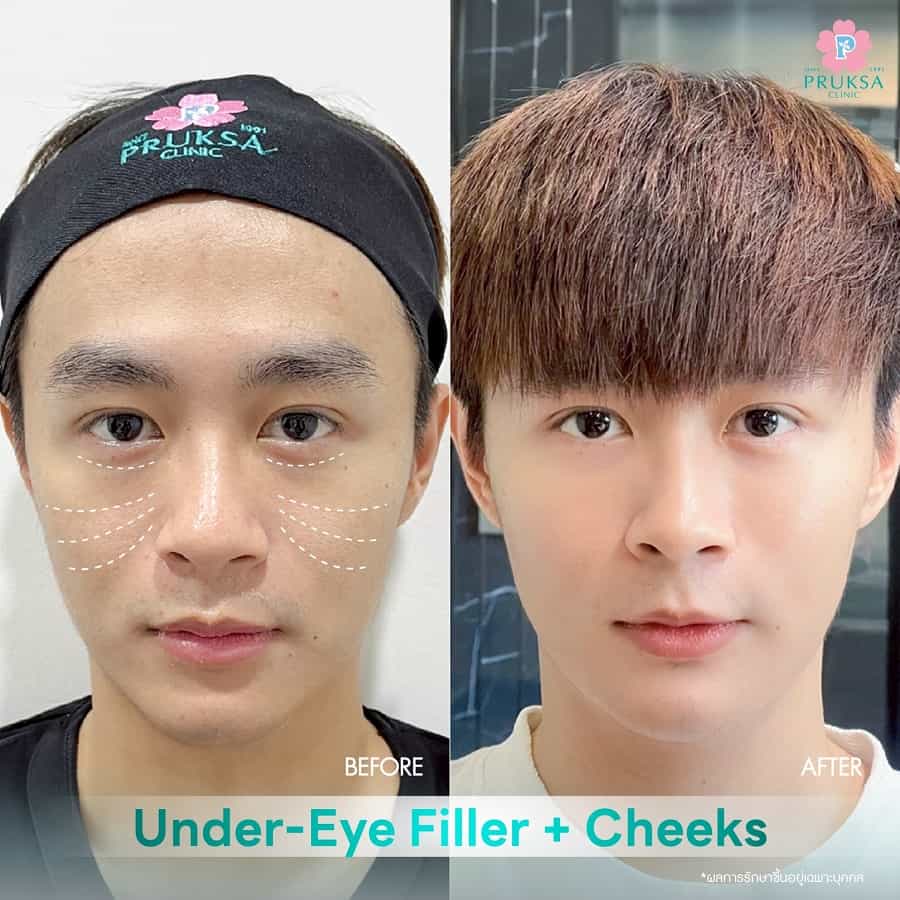 Under-Eye & Cheek Filler – Structural Rejuvenation