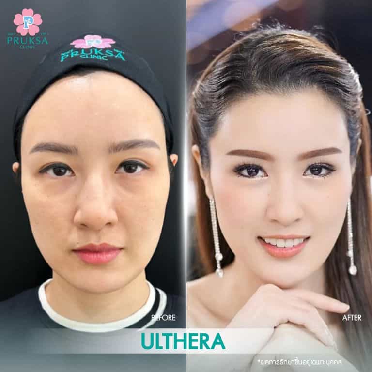 Under-Eye Filler – Primary Case