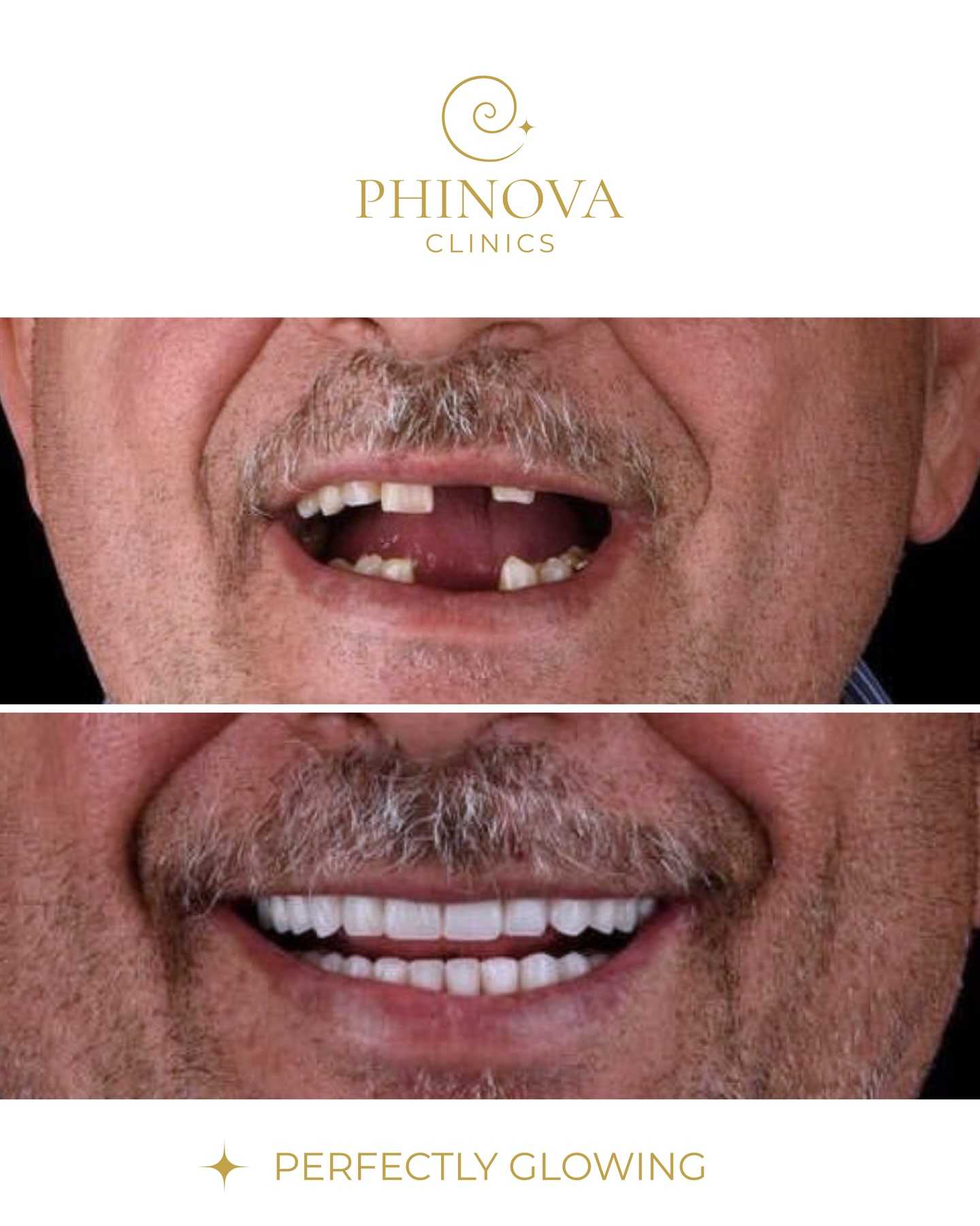 صور قبل وبعد عملية زراعة الشعر بتقنية "أول-أون-4" في إزمير، تركيا، بواسطة عيادات فينوفا.