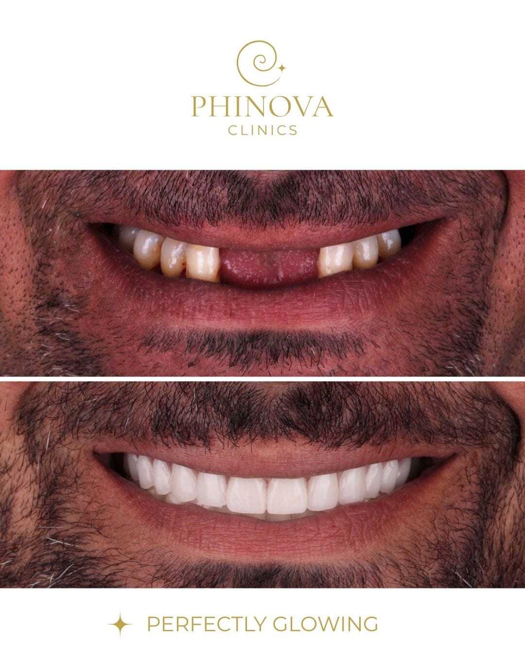 صور قبل وبعد زراعة الأسنان في إزمير، تركيا