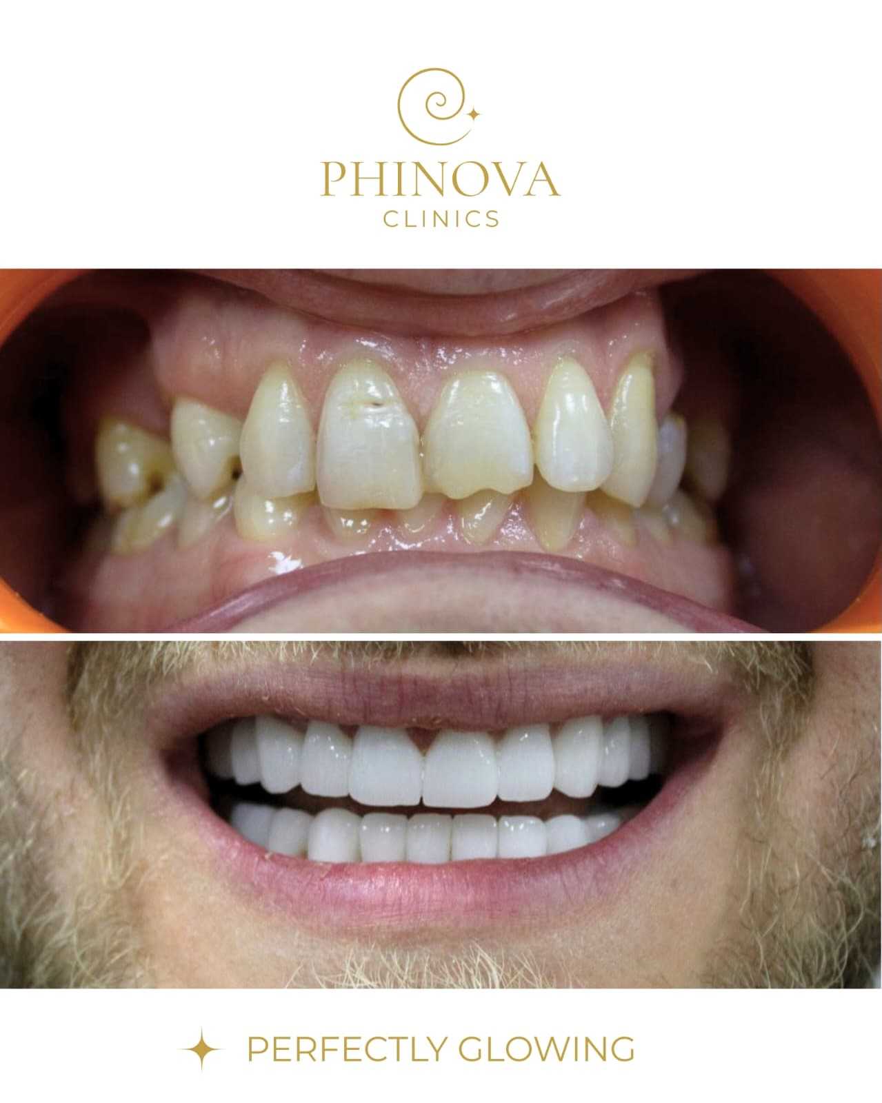 قبل وبعد عملية تجميل الابتسامة في إزمير، تركيا