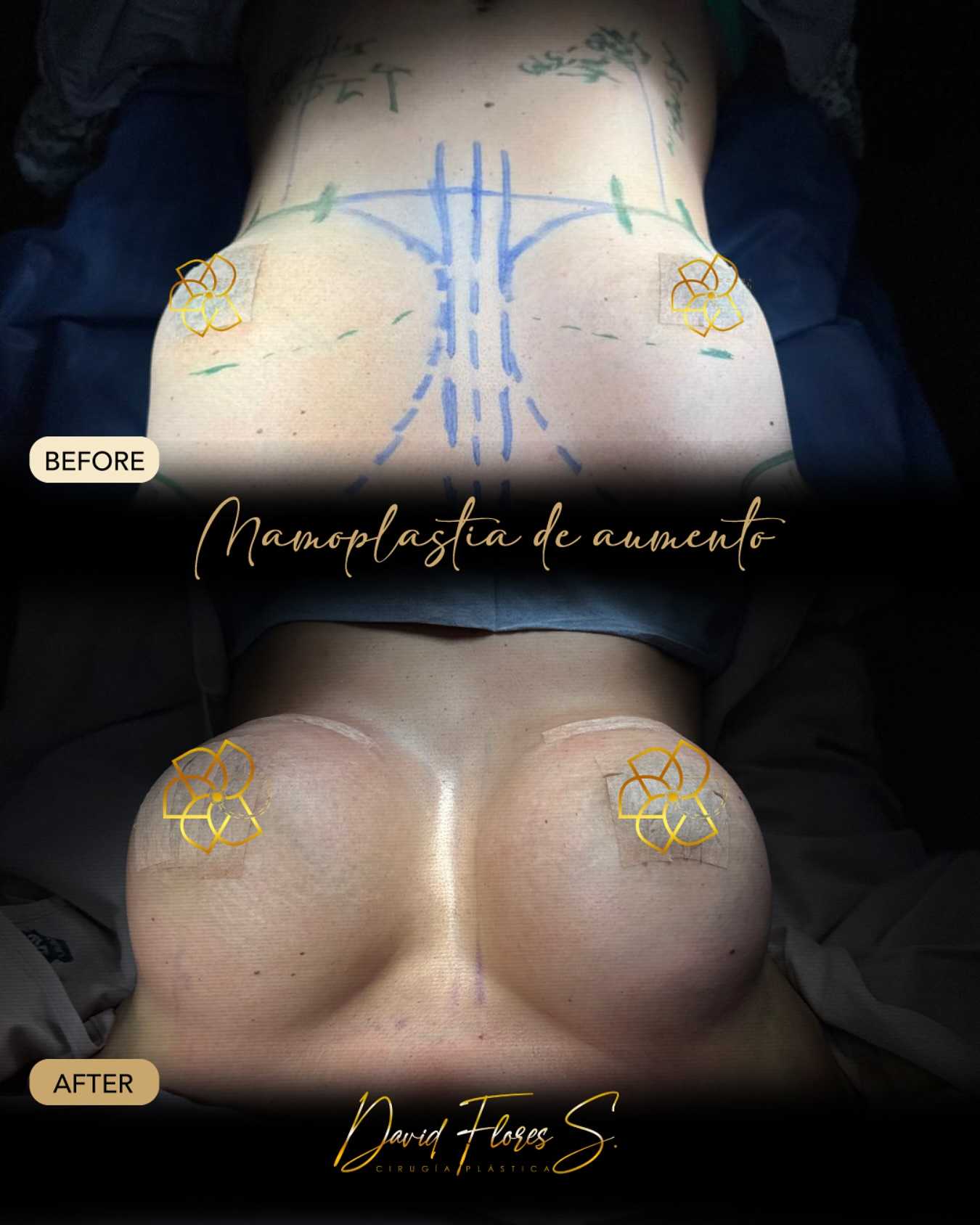 Before and After Breast Augmentation in Juarez