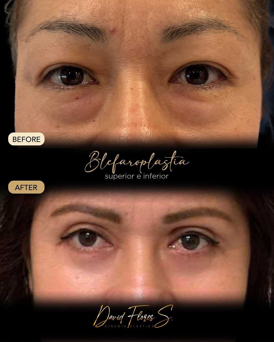 Before and After Eyelid Surgery in Ciudad Juarez Mexico
