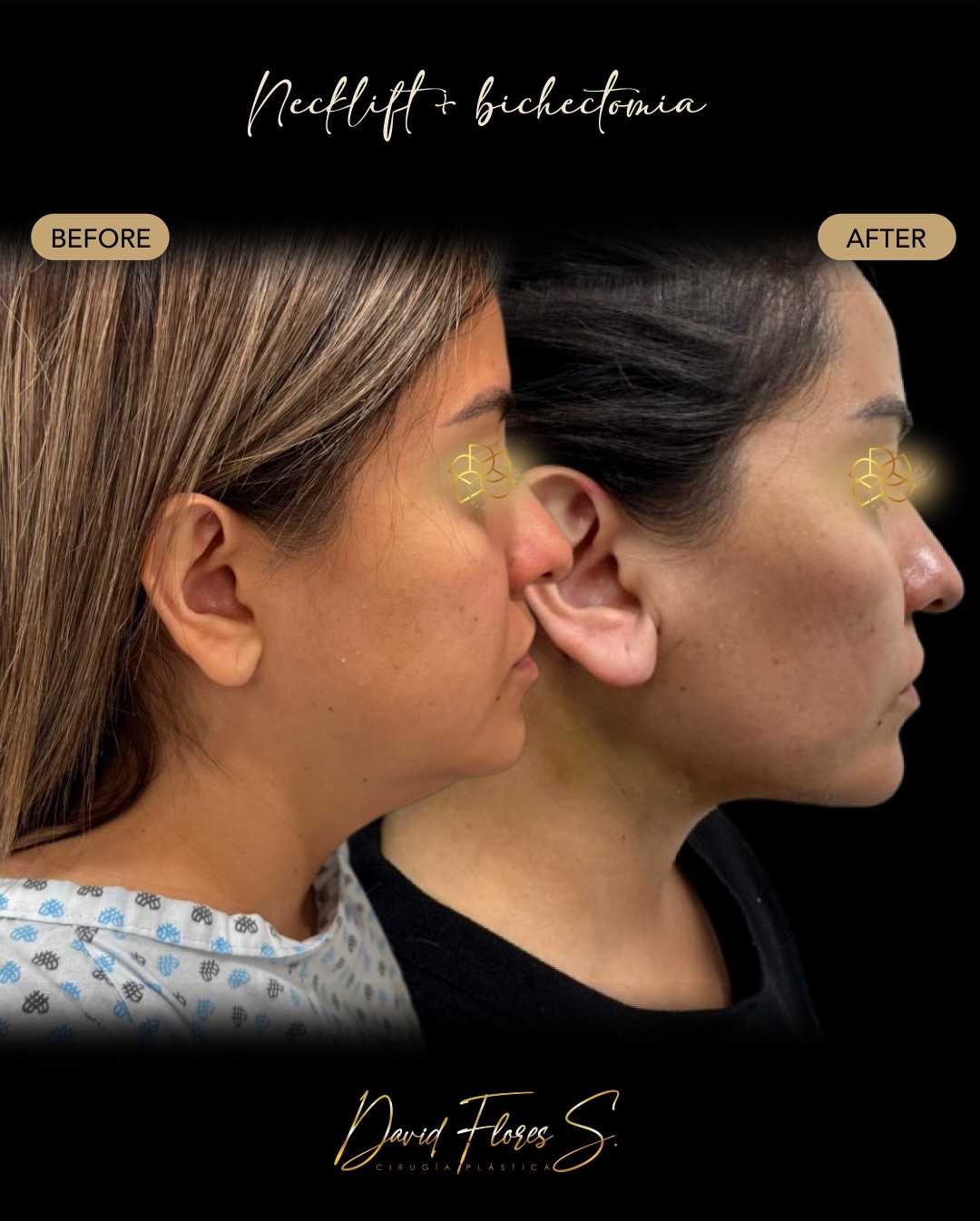 Before and After Neck Lift in Ciudad Juarez Mexico