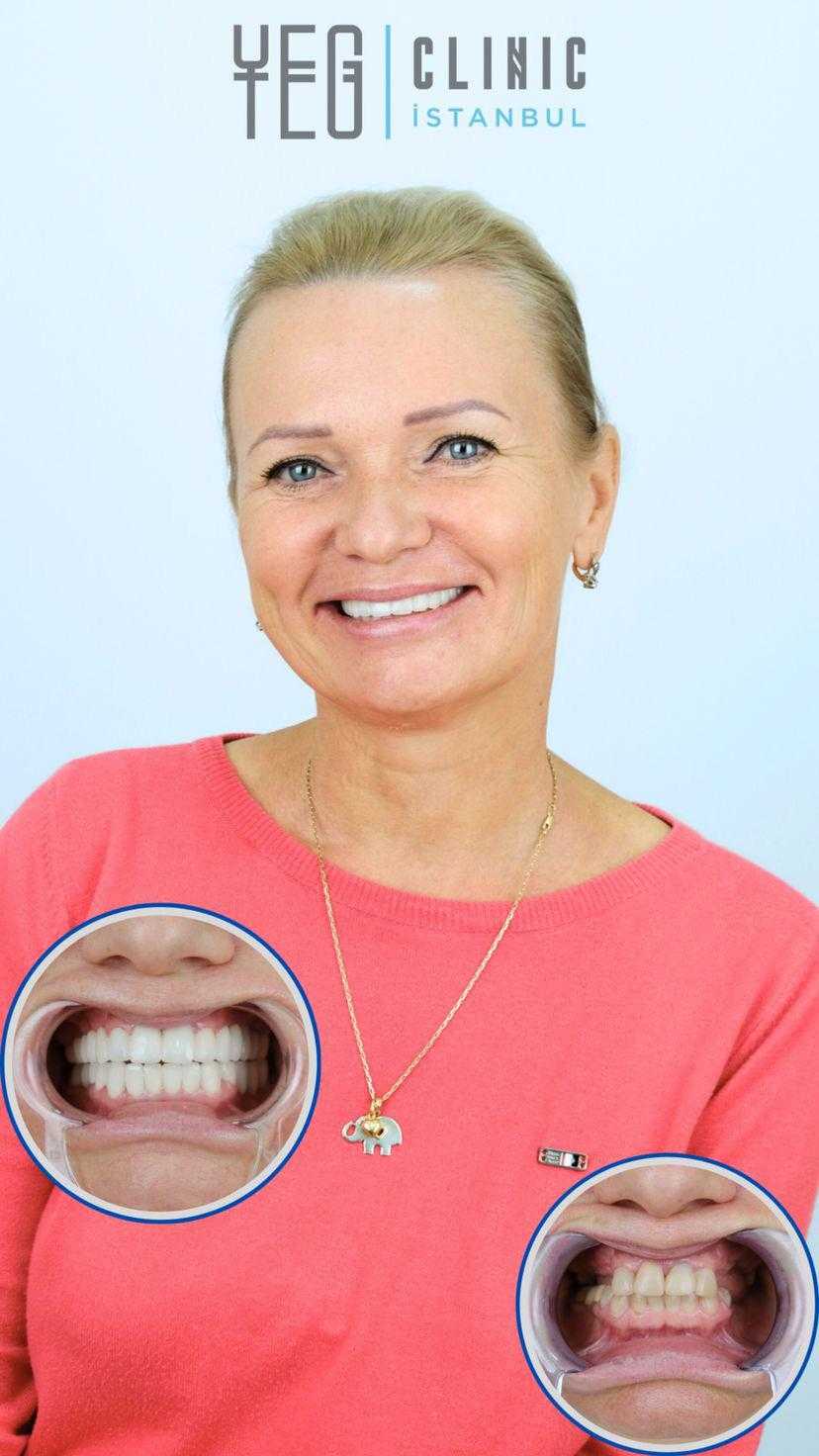 Before and After Image for Zirconium Crowns in Istanbul, Turkey