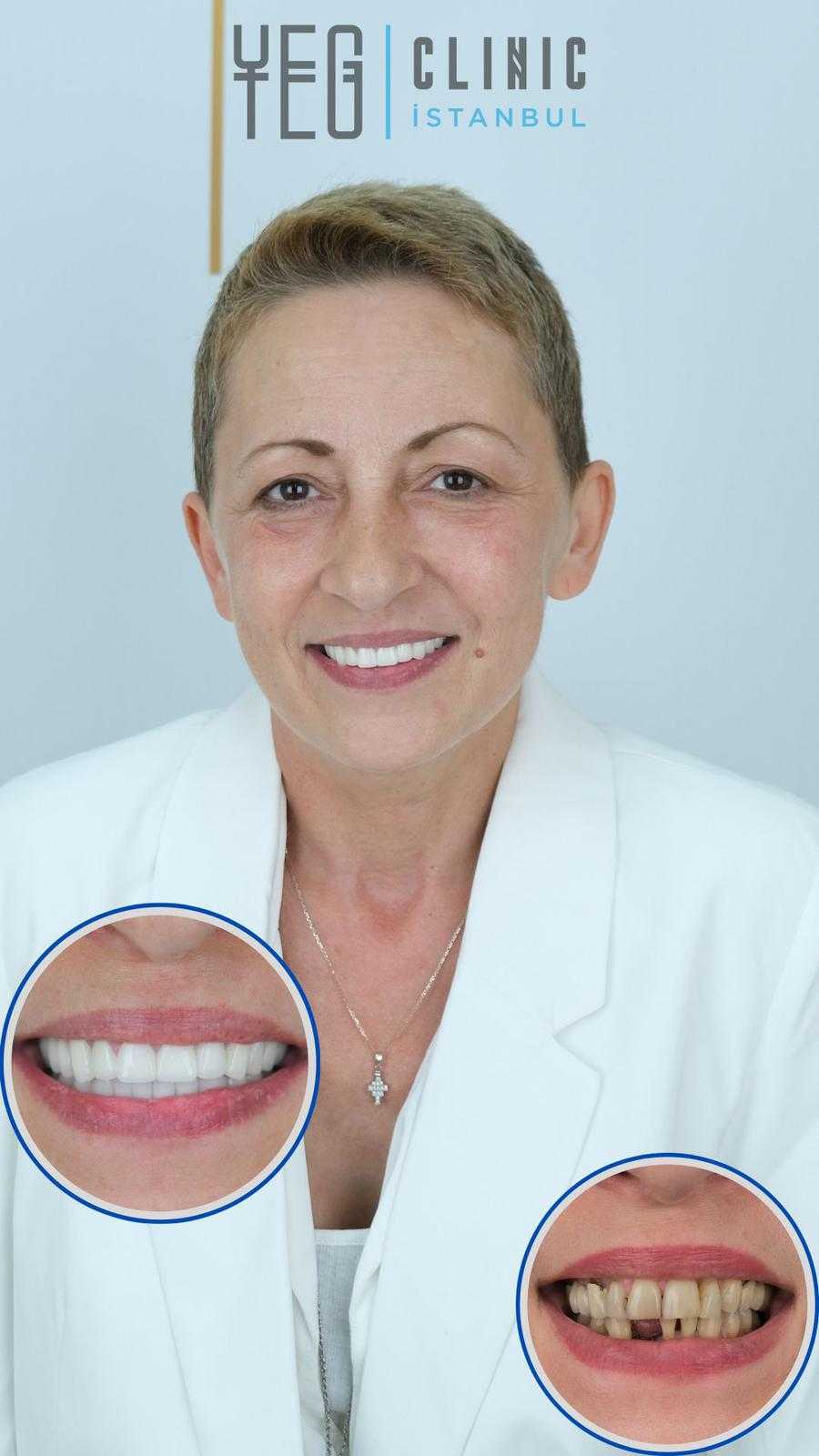 Before and After Image for Zirconium Crowns in Istanbul, Turkey