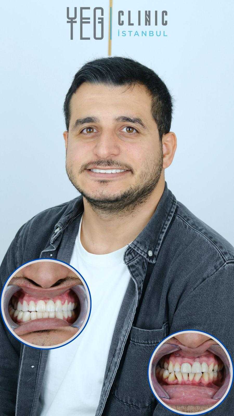 Before and After Image for Zirconium Crowns in Istanbul, Turkey