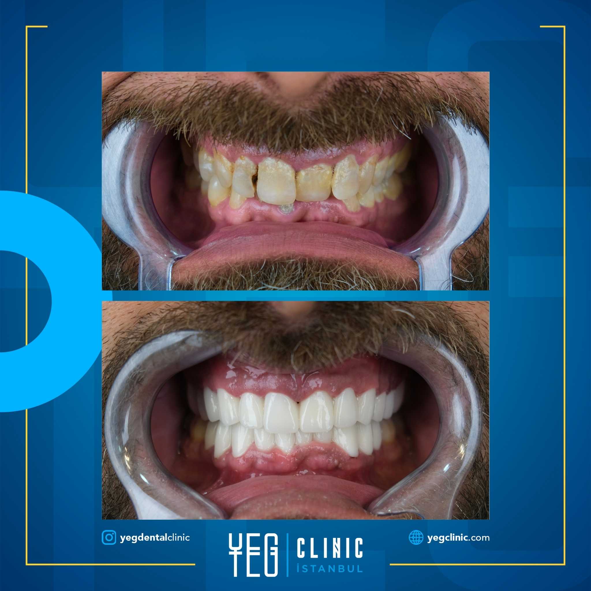 Before and After Image for Zirconium Crowns in Istanbul, Turkey