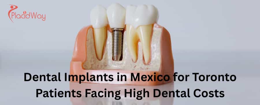 Dental implants in Mexico