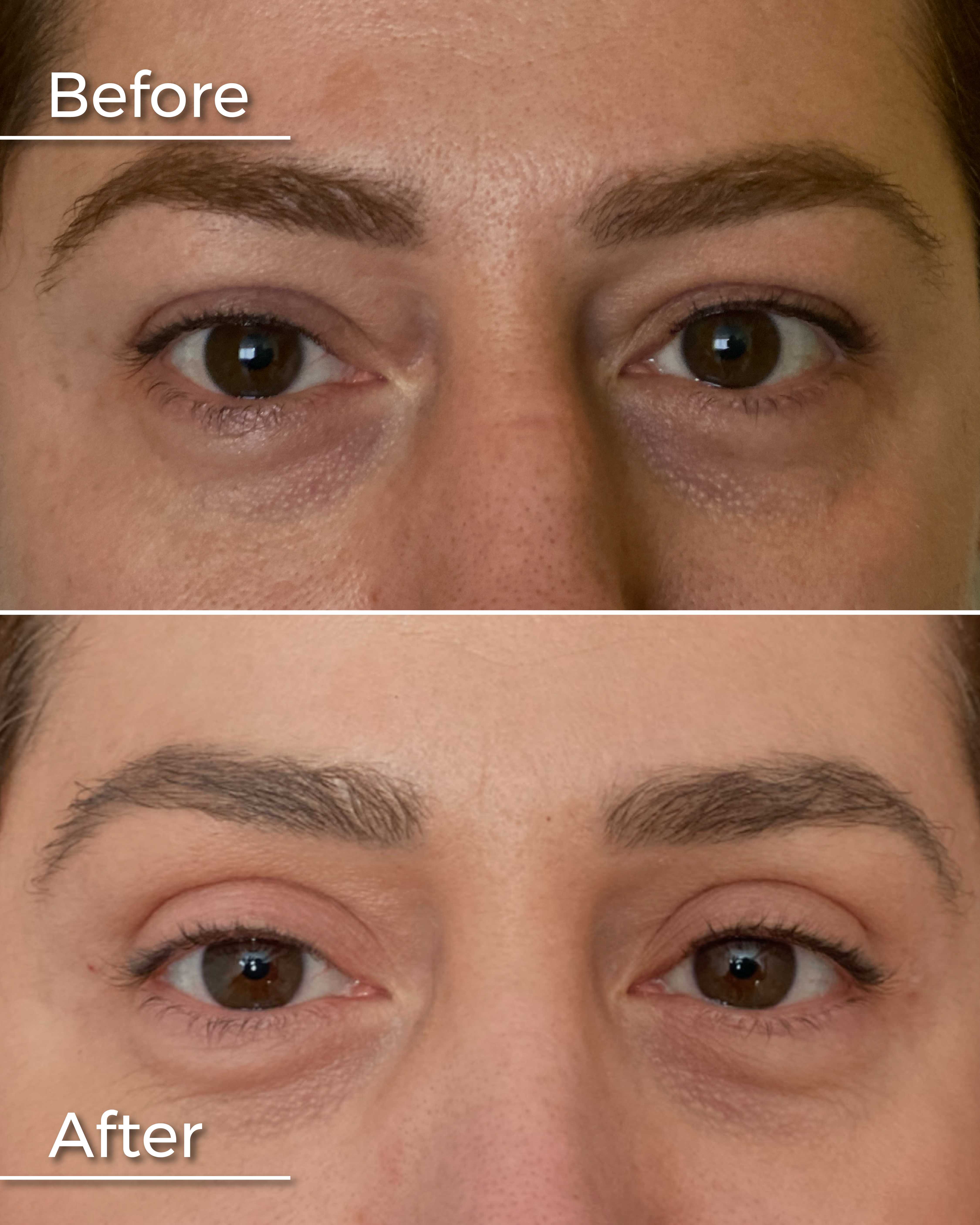 Before and After Eyelid Surgery in Armenia