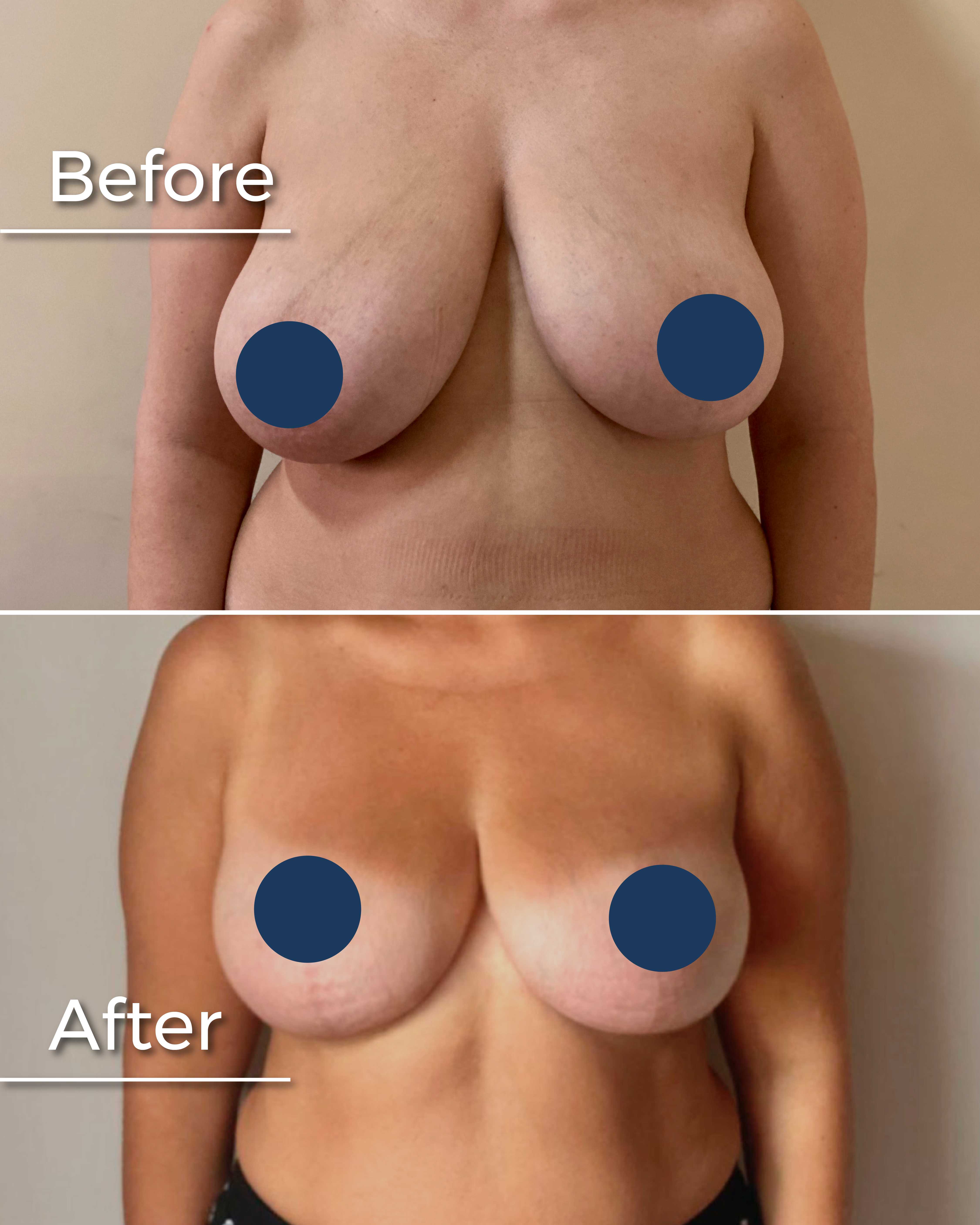 Before and After Breast Augmentation in Armenia