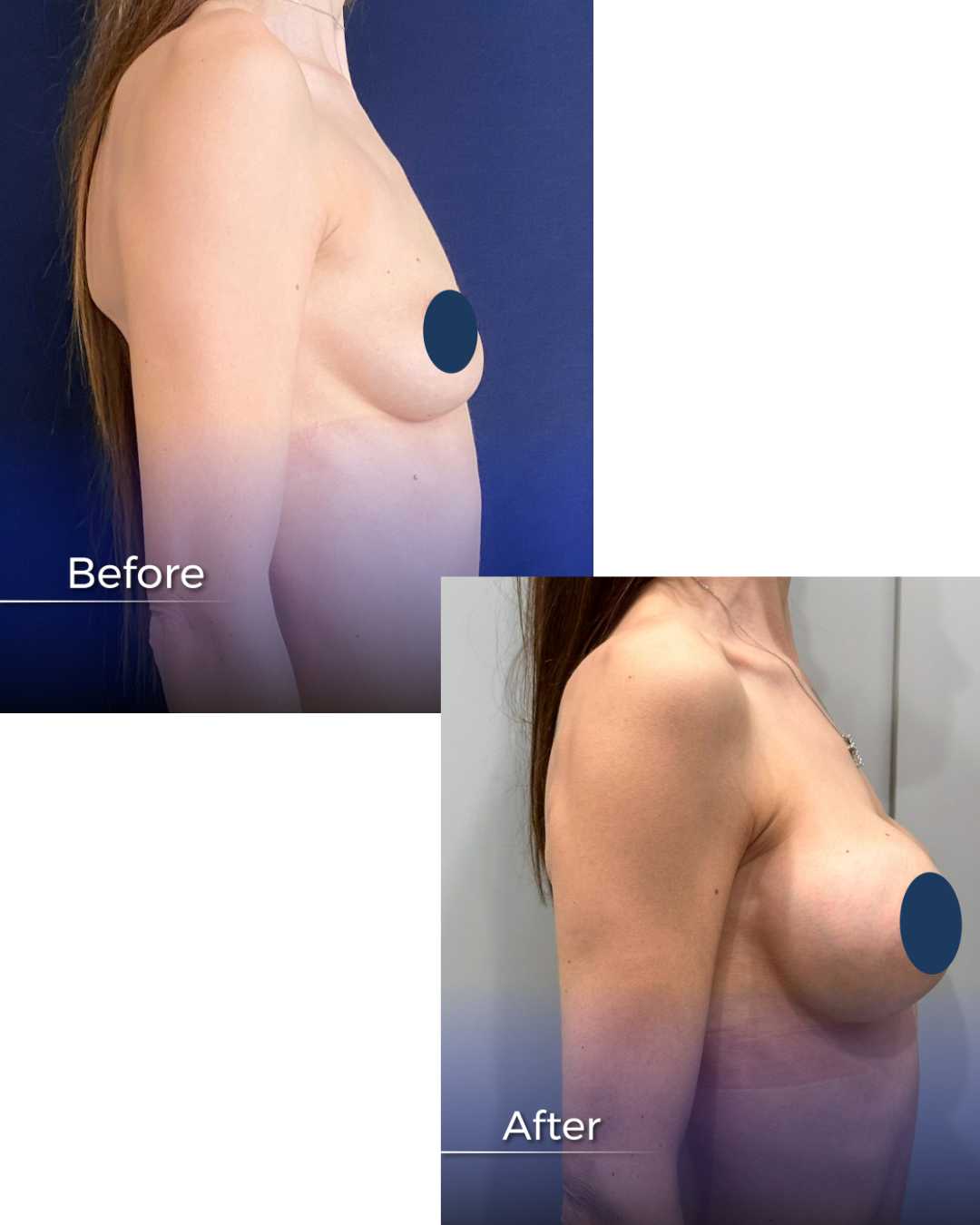Before and After Breast Lift in Armenia