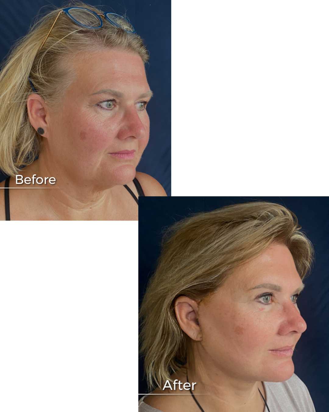 Before and After Facelift in Armenia