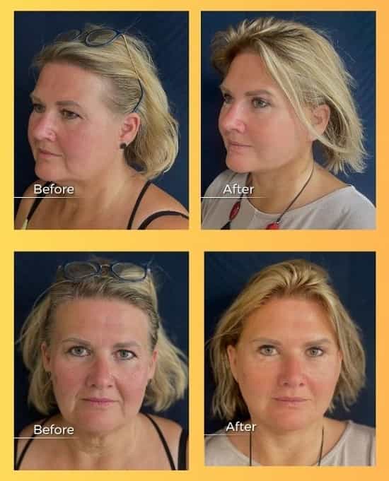 Facelift in Armenia Before and After Images