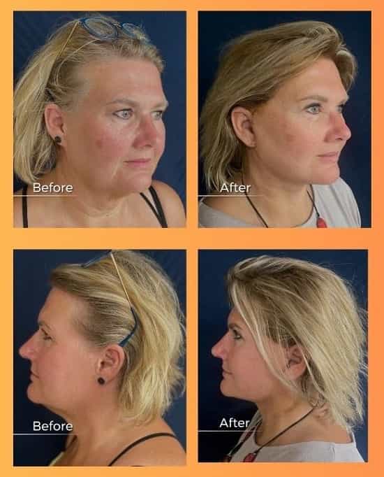 Face Lift in Armenia Before and After Images