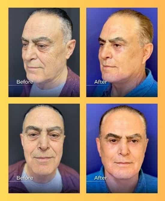Face Lift Surgery in Armenia Before and After Images