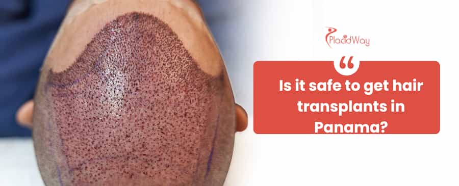 hair transplant in Panama