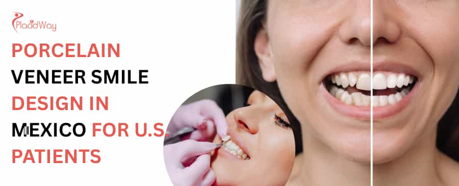 Porcelain Veneer Smile Design in Mexico for U.S. Patients