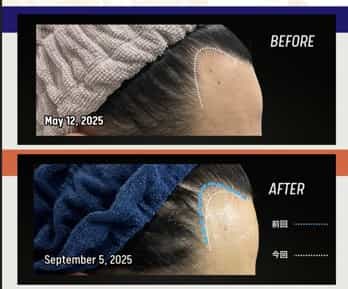 Stem Cell Therapy for Hair Growth in Japan