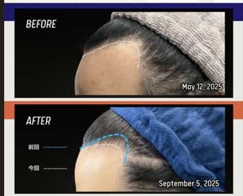 Stem Cell Therapy for Hair Loss in Japan
