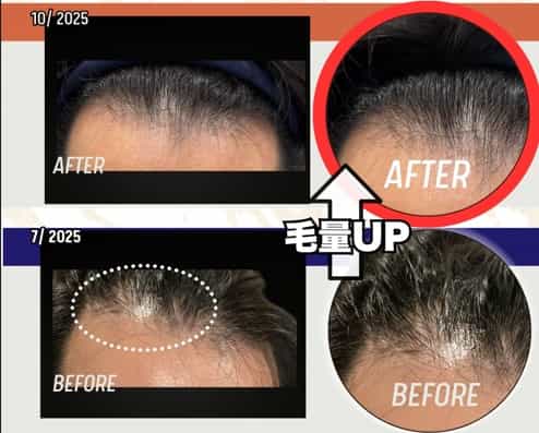 Stem Cell Treatment for Hair Loss in Japan