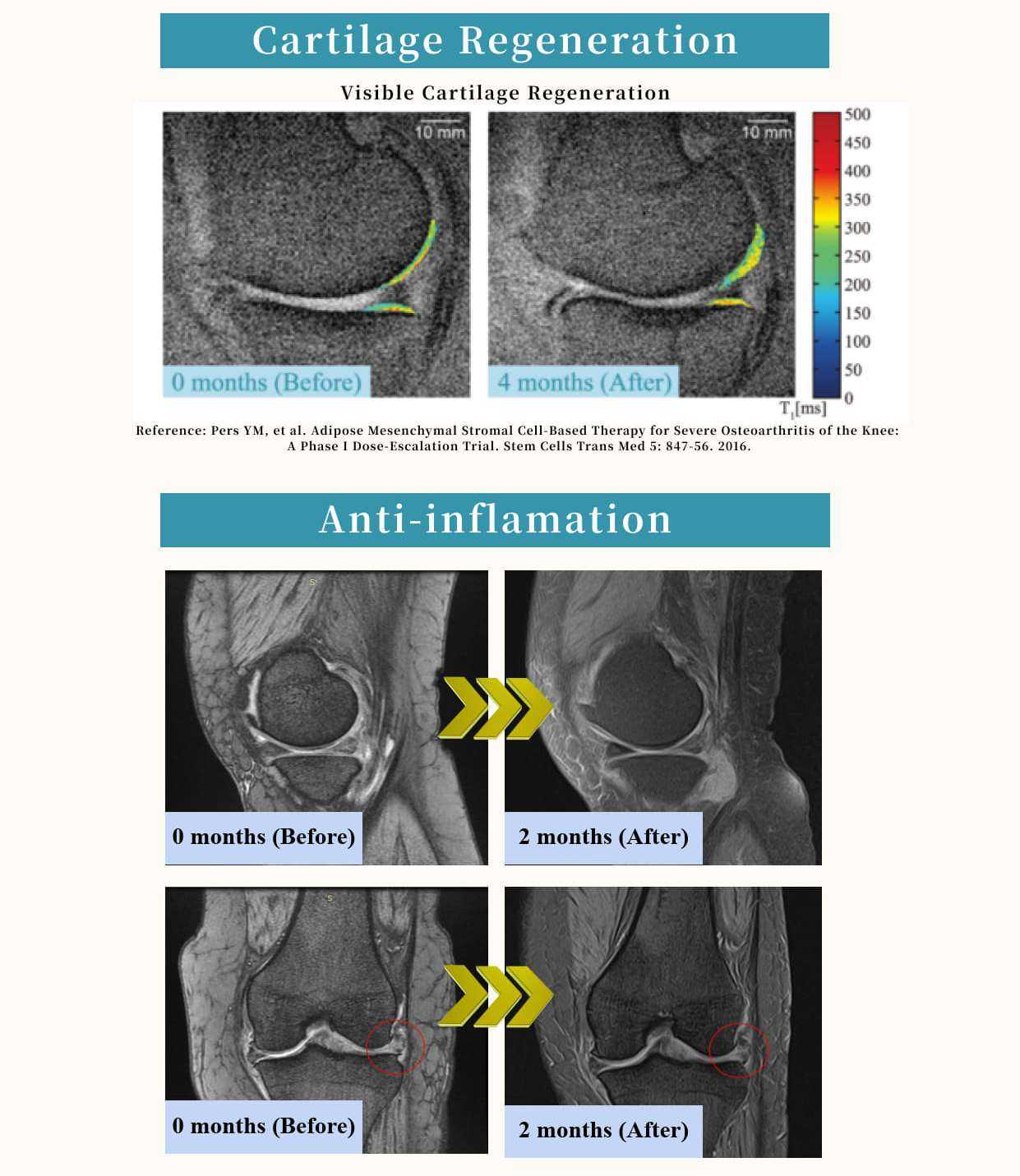 Before-and-After Images: Stem Cell Therapy for Knee Pain in Japan