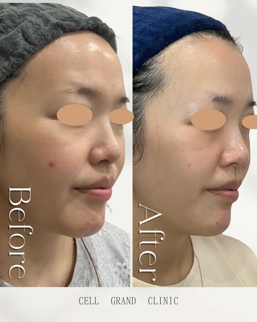 Stem Cell Therapy for Women in Their 30s Using Fibroblasts in Japan Before-and-After Images