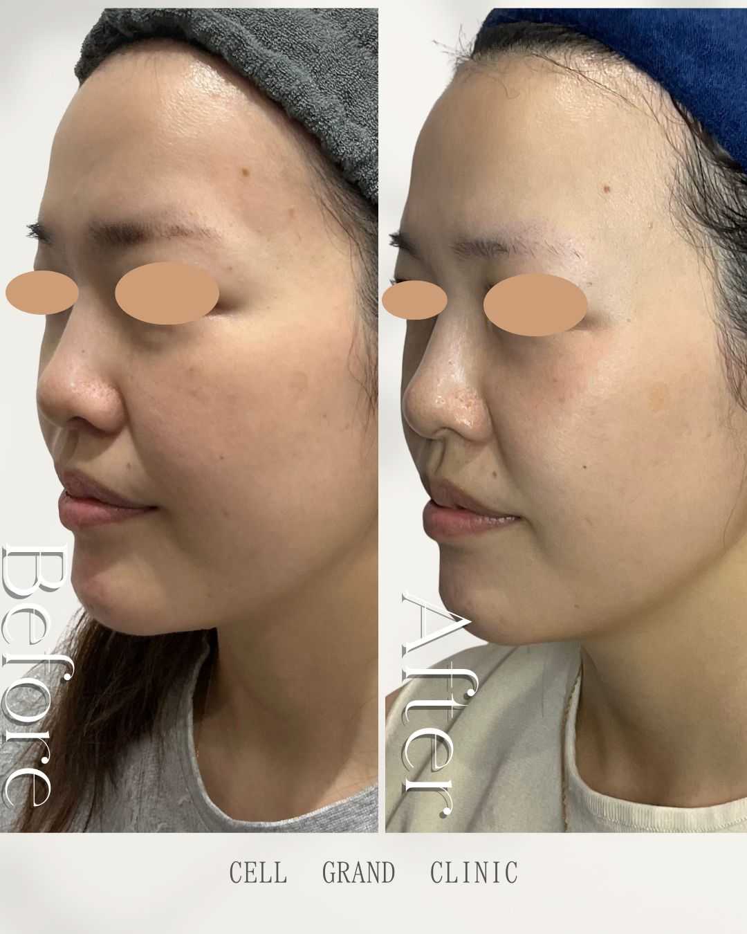 Before-and-After for Stem Cell Therapy for Women in Their 30s Using Fibroblasts in Japan