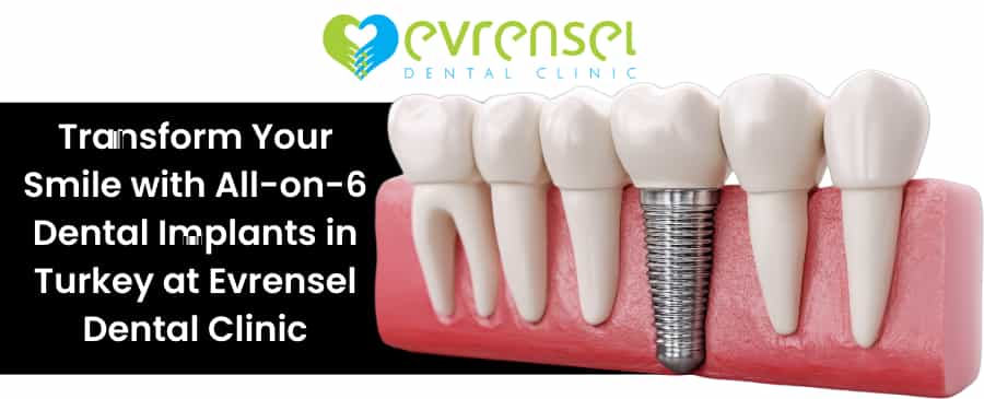 dental implants in Turkey