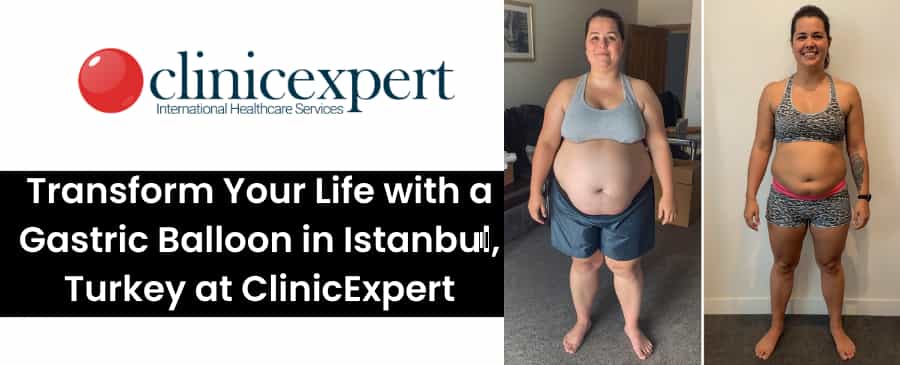 Gastric Balloon in Istanbul