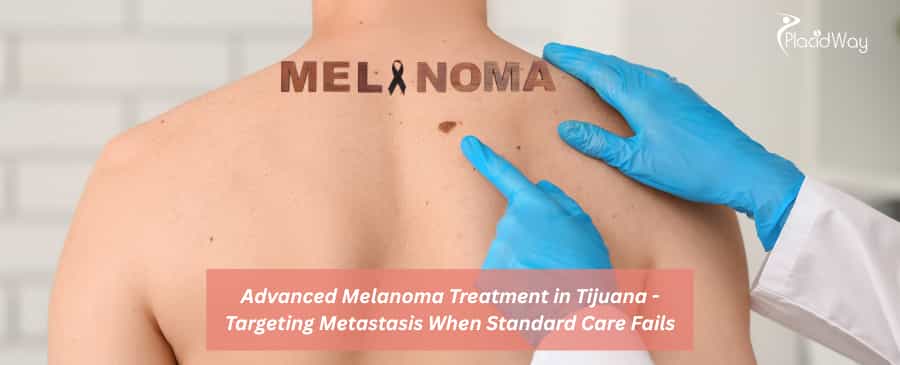 Advanced Melanoma Treatment in Tijuana 