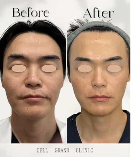 Skin Stem Cells Japan Before After Image