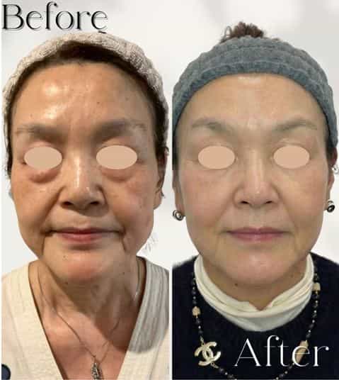 Skin Stem Cells Japan Before After Picture