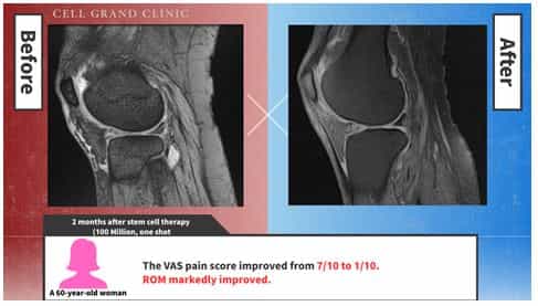 Knee Stem Cells Japan Before After Image