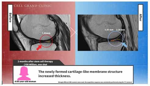 Knee Stem Cells Japan Before After Picture