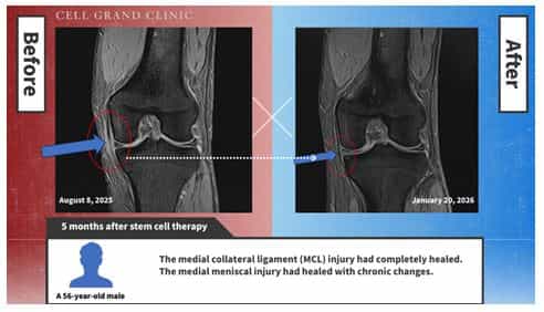 Knee Stem Cells Japan Before and After Image