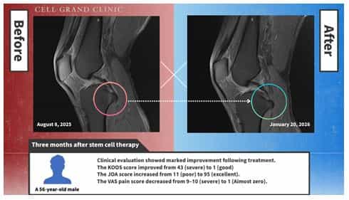 Knee Stem Cells Japan Before and After Picture