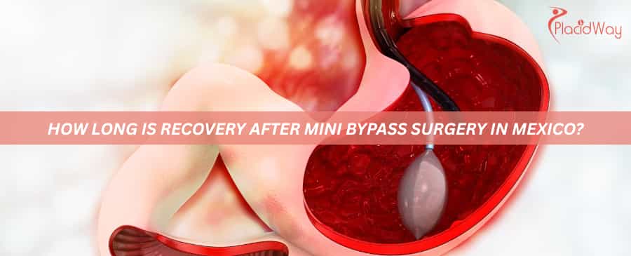How long is recovery after mini bypass surgery in Mexico?