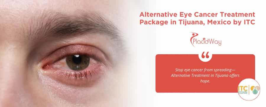 Paquete de tratamiento alternativo para el cáncer de ojo en Tijuana, México, ofrecido por ITC.