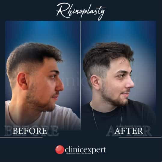 صور قبل وبعد عملية تجميل الأنف في إسطنبول، تركيا