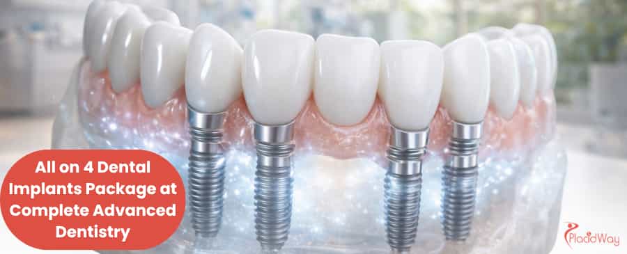 Dental Implants in Mexico
