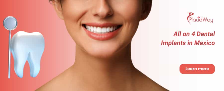 All on 4 Dental Implants in Mexico
