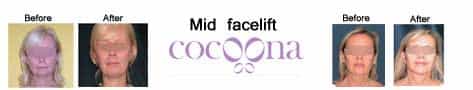 Facial