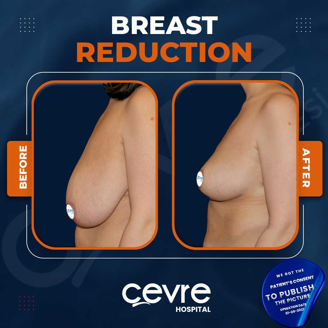 Breast Reduction