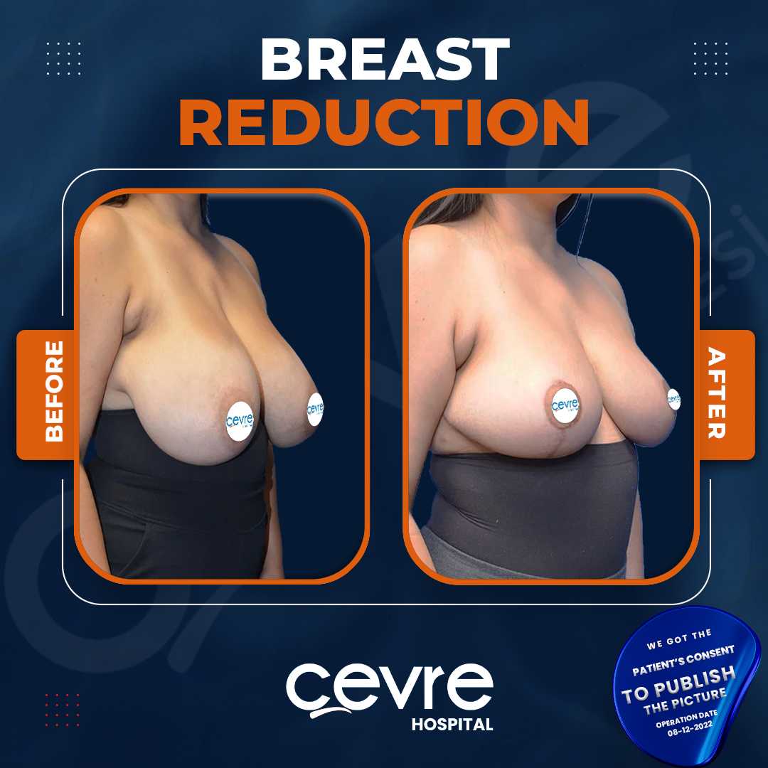 Breast Reduction