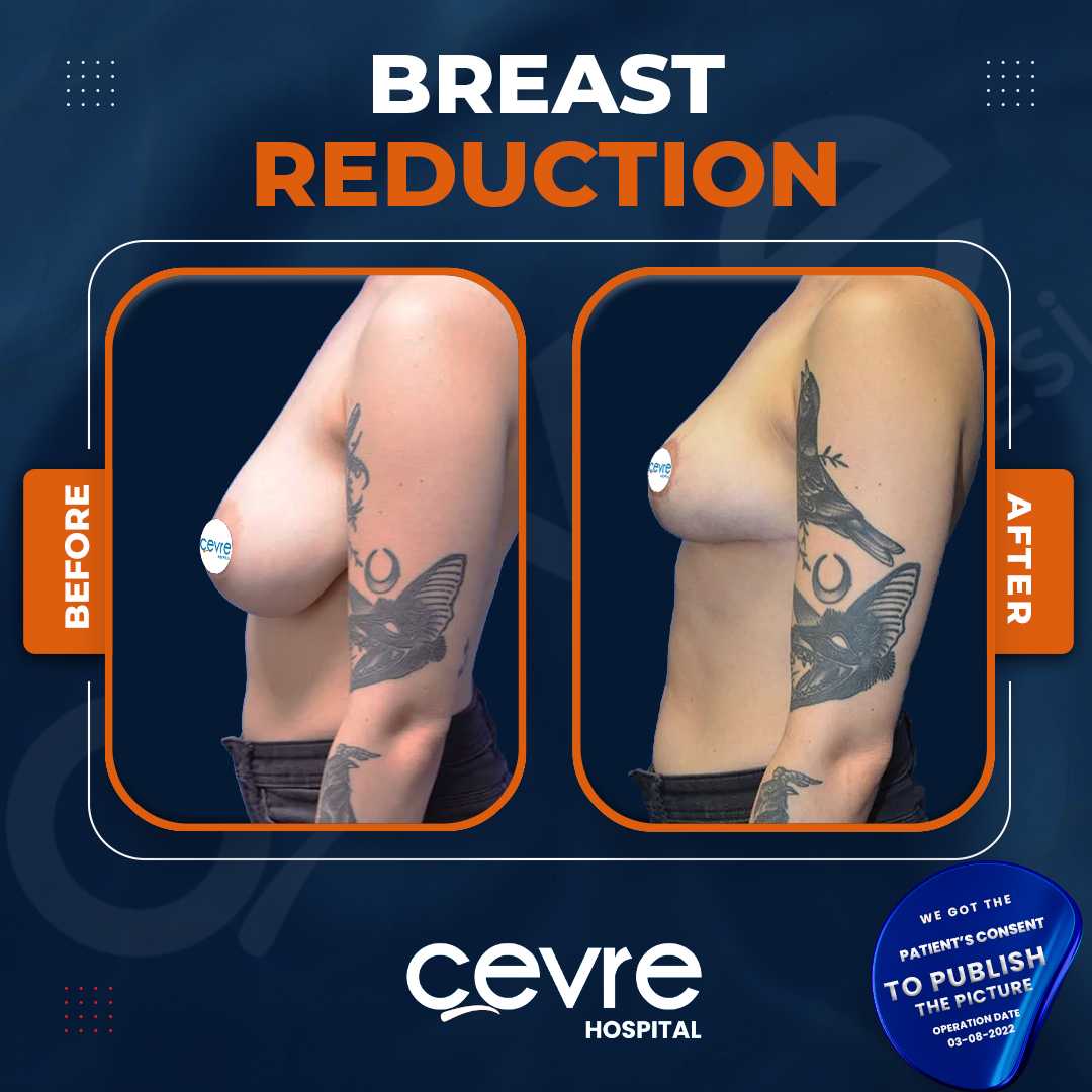 Breast Reduction